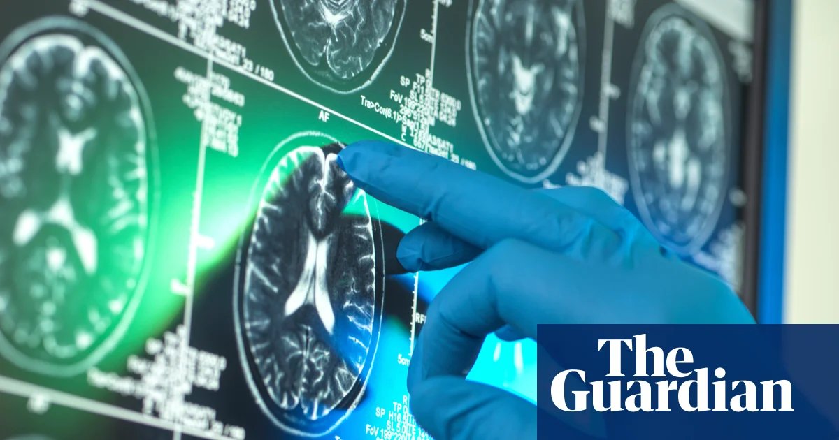 Alzheimer’s research is latest casualty in Trump administration war against ‘DEI’ | Trump administration