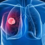 PDPI: Lung Cancer Now Affects Patients in Their 20s