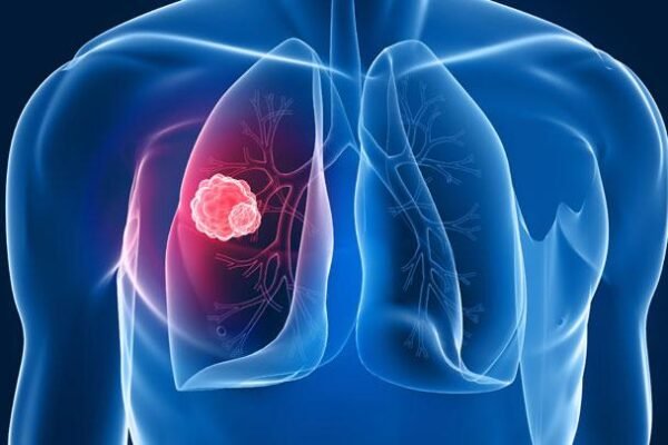 PDPI: Lung Cancer Now Affects Patients in Their 20s