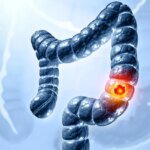 Why Is Colorectal Cancer Rising in People Under 50? New Clues Point to the Environment