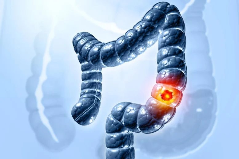 Why Is Colorectal Cancer Rising in People Under 50? New Clues Point to the Environment