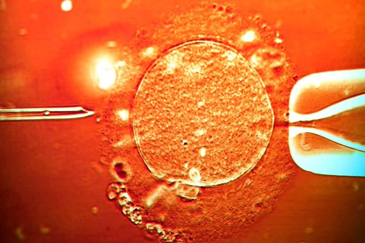 How doctors retrieve sperms from infertile men, help them become fathers